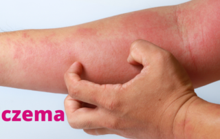 Eczema gut health