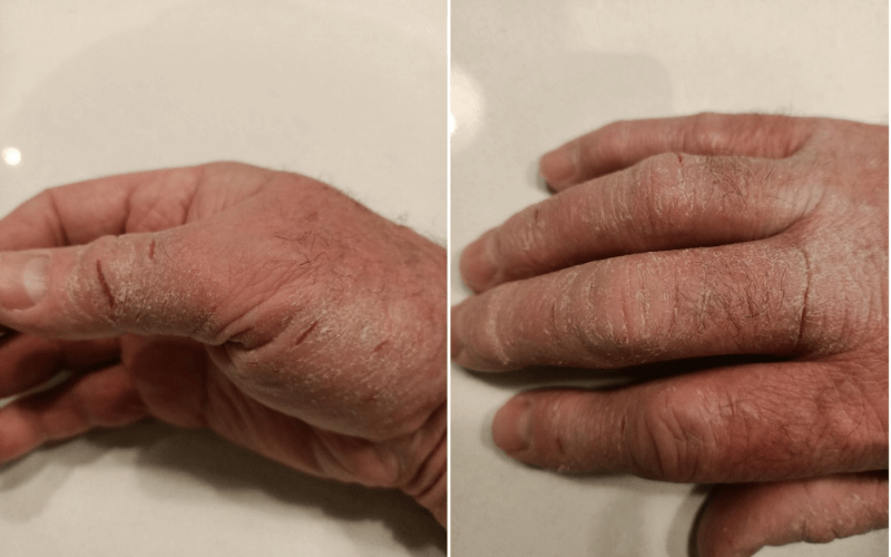 Eczema diet - before photos