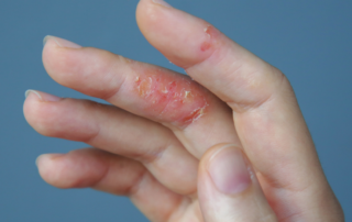 Eczema on hands